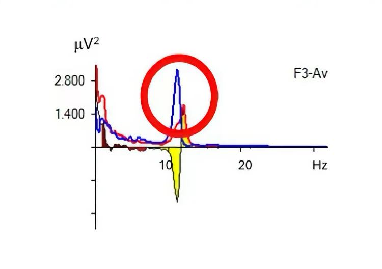 Toward an AI-Supported Clinical Pathway for EEG-Guided Transcranial Electric Stimulation in Autism Spectrum Disorder